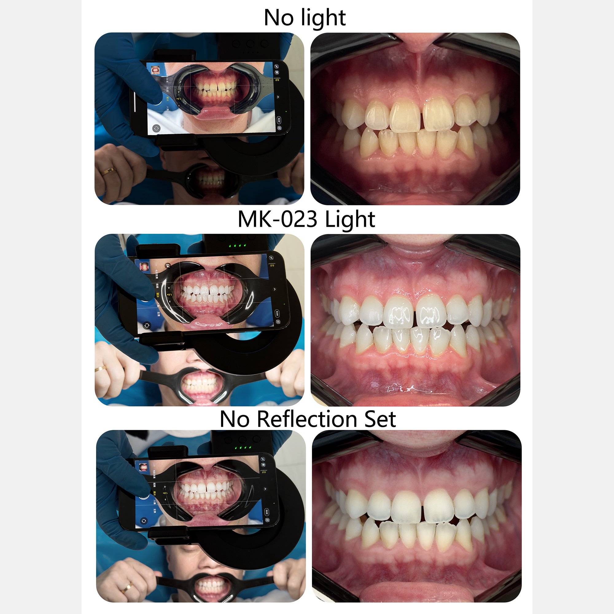 HERA MK-23 Intraoral Dental Ph - Photography Treatment avaliação e preço