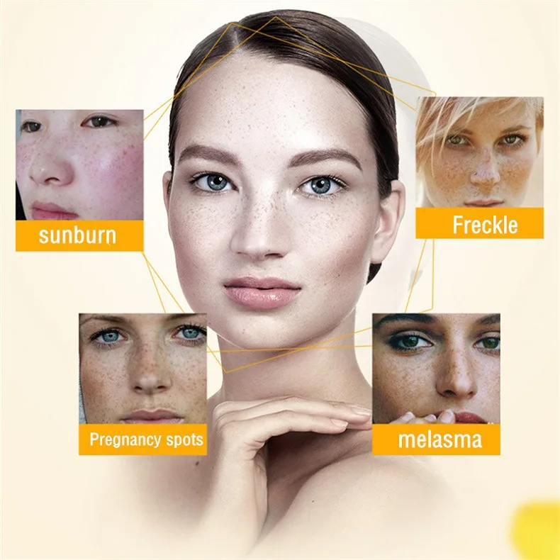 Whitening Freckle Cream Remove - Photography Treatment avaliação e preço