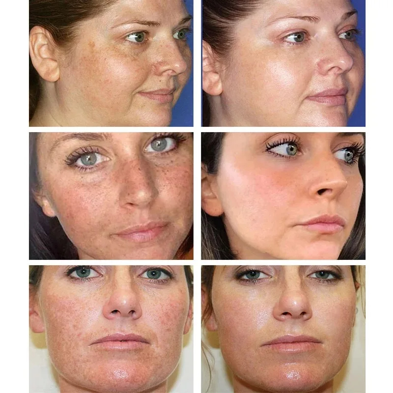 Whitening Freckle Cream Remove - Photography Treatment avaliação e preço